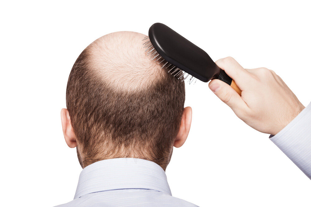 man with hair loss brushing his hair